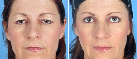 All eye lift surgery photos are of patients of prasad cosmetic surgery, with offices in garden city, long island, ny and the upper east side of manhattan, new york city. Brow Lift & Eyelid Lift with Dermabrasion - Swan Center ...