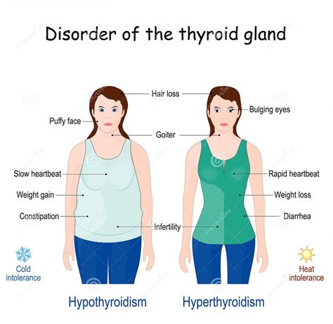Hypothyroidism Symptoms Causes Diagnosis And Much More