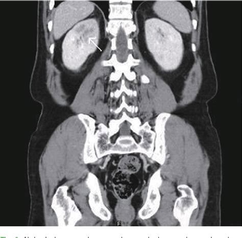 Figure 2 From Eosinophilic Granulomatosis With Polyangiitis Accompanied