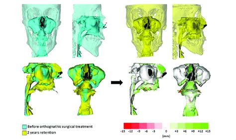 Airway Volume Changes Visualized With Superimpositions Of Cbct Images