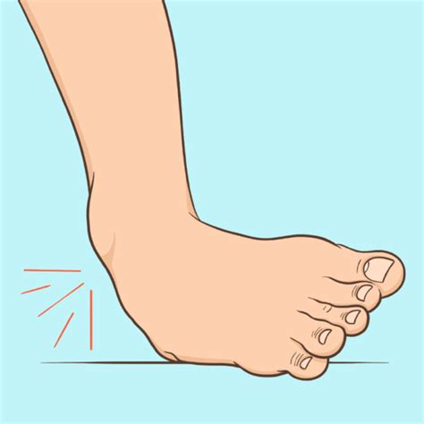 How To Quickly Recover From A Sprained Ankle Laptrinhx News