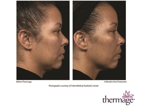 Thermage Syracuse Plastic Surgery