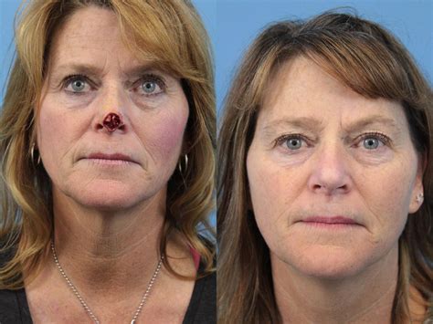 Skin Cancer Repair Before And After Pictures Case 140 West Des Moines