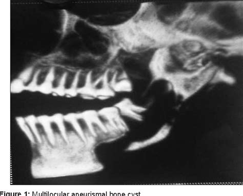 Figure 1 From Aneurysmal Bone Cyst Of Mandible A Case Report