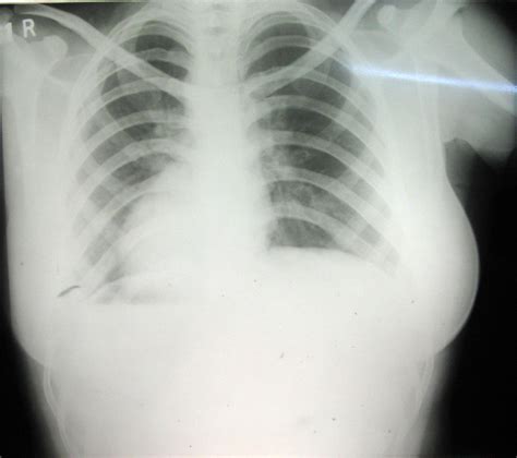 Inverted P wave - wikidoc