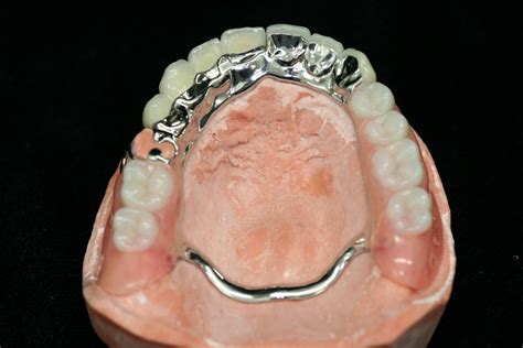 What Do Removable Partial Dentures Look Like Design Talk