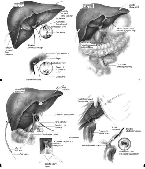 Surgical Treatment Of Choledochal Cysts Lipsett 2003 Journal Of