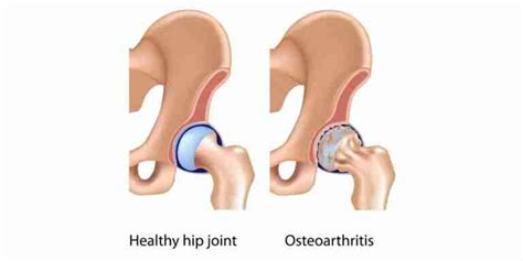 5 Common Causes Of Hip Pain Hip Pain Specialist