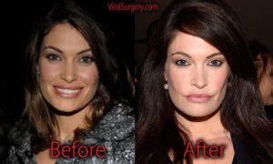 Kimberly Guilfoyle Plastic Surgery, Before and After Botox ...