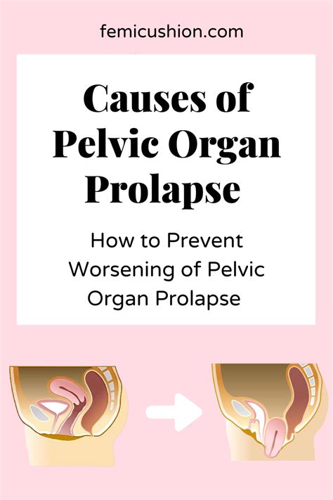 Reasons Why Pelvic Organ Prolapse Happens Causes Of Vaginal Prolapse Femicushion Artofit