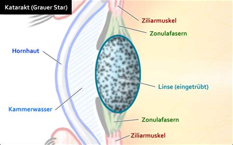 Grauer Star Symptome Ursache And Therapie Katarakt Lasikon