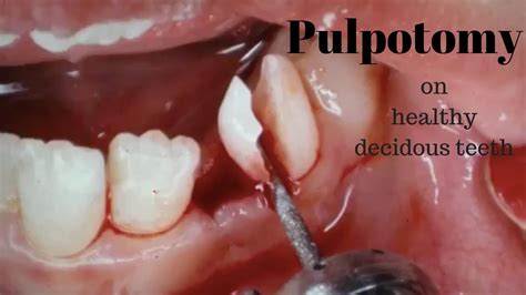 Pulpotomy On Healthy Deciduous Teeth Youtube