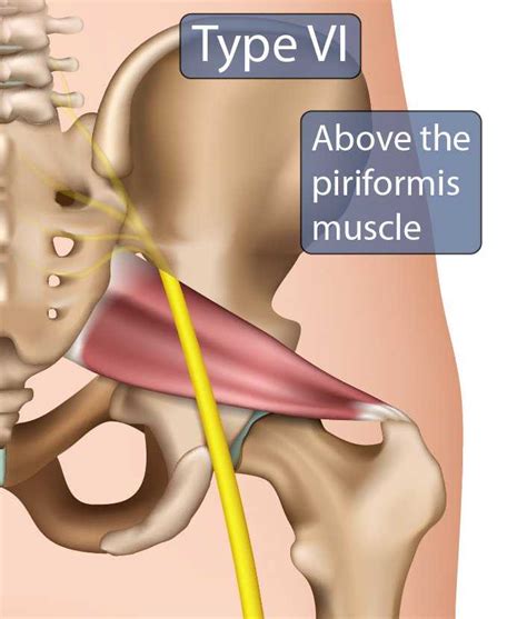 Most sides were found to have 1 location for sciatic nerve intercommunications. Sciatica Symptoms, Diagnosis & Treatment | Miami ...