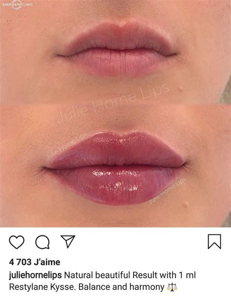 Lips Fillers Lips Kiss Lips Natural Lips Shape Lips Women Without