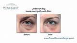 Fillers For Under Eye Bags Side Effects Images