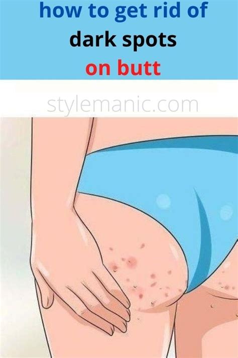 There are some special lotions and creams. How To Get Rid Of Dark Spots On Butt | Style Manic