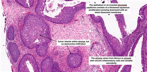 Hopkins Pathology On Twitter Inverted Sinonasal Papilloma Sinonasal