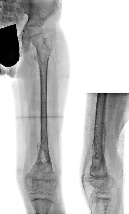Ap And Lat Radiographs Of The Femur 2 Weeks After Frame Removal