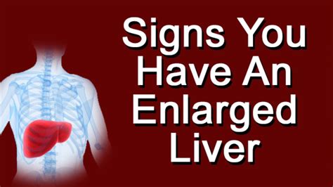 Signs You Have An Enlarged Liver Youtube