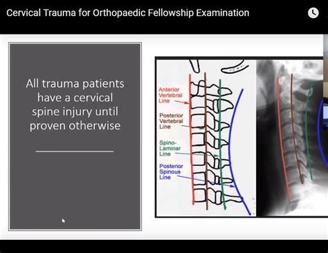 Cervical Spine Trauma For The Frcs Orth Orthopaedicprinciples Com