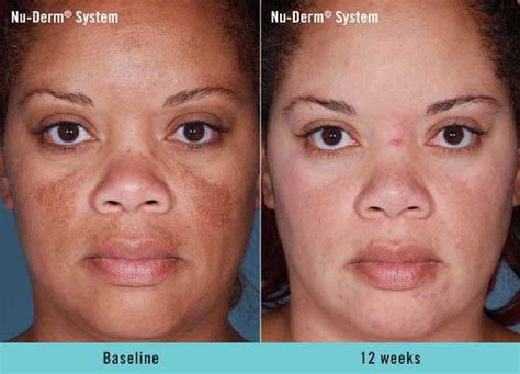 Post Inflammatory Hyperpigmentation Treatments To Lighten The Skin