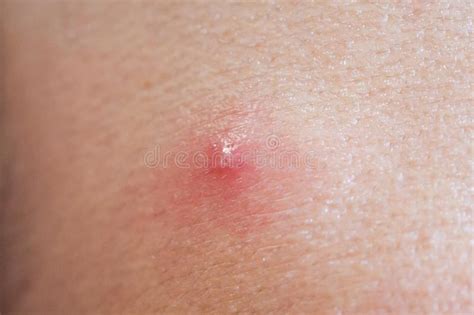 Inflammatory Acne With Red Spot On Face Closeup Stock Photo Image Of