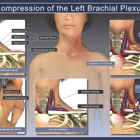 Comparison Of A Normal And Compressed Left Brachial Plexus