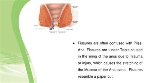 Treatment For Anal Fissures In Hyderabad