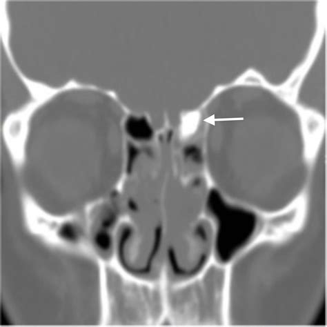 Cureus A Case Of Giant Ethmoid Sinus Osteoma