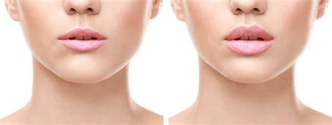 How long does it take for botox lip flip to kick in. Lip Augmentation Ocala The Villages Florida