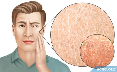 Dry Skin Causes And Treatments