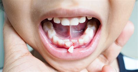 When Is Tooth Extraction The Only Option Top Notch Dental