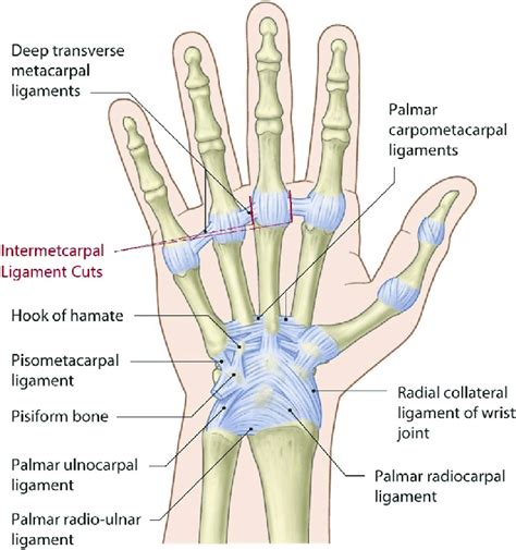 Diagram Showing Where To Make Intermetacarpal Ligament Cuts When