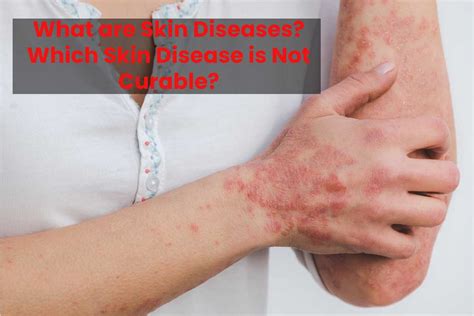 What Are Skin Diseases Which Skin Disease Is Not Curable