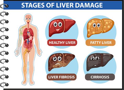 Diagram Showing Stages Of Liver Damage 6154055 Vector Art At Vecteezy