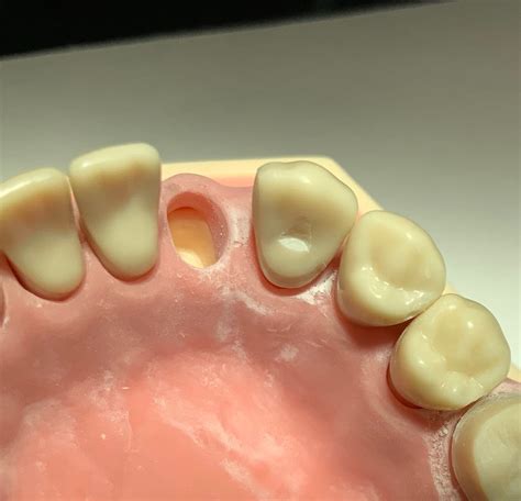 Resin Bonded Cantilever Bridge Anterior Toothpreps