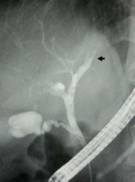 Ercp Shows Complete Obstruction Of The Left Intrahepatic Bile Duct