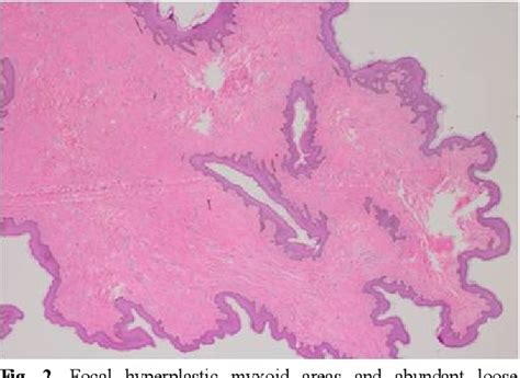 Figure 2 From A Case Of Giant Fibroepithelial Polyp Of The Vulva