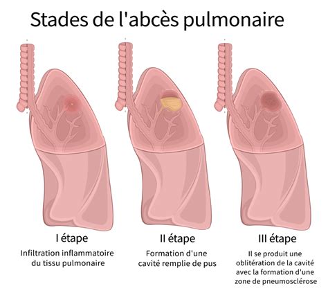Abcès Du Poumon Causes Conséquences Et Traitements Information
