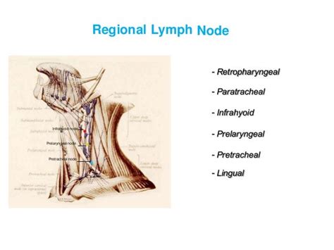 Infrahyoid Lymph Node