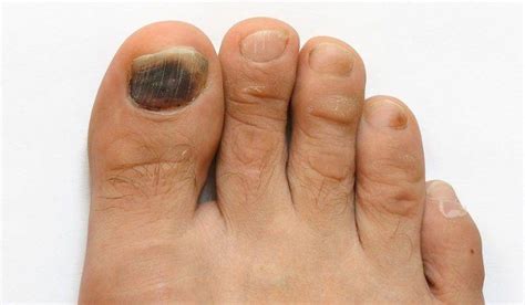 A rare infection called mucormycosis, or the black fungus. Getting Rid of Finger Fungus: a comprehensive Guide | Mla ...
