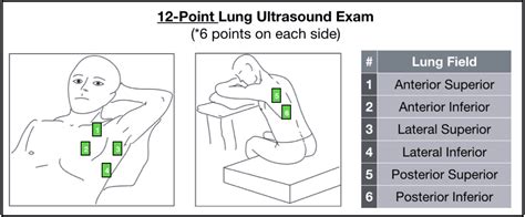 Complete Guide To Lung Ultrasound In Covid 19 Coronavirus Patients
