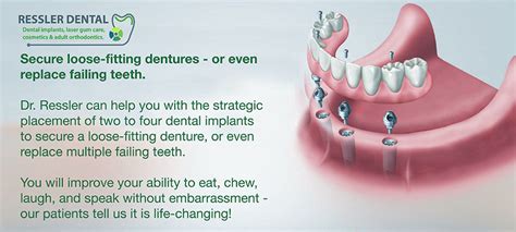 Secure Loose Dentures With Dental Implants Delray Beach Implant