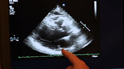 Maybe you would like to learn more about one of these? Echocardiogram Demonstration - YouTube