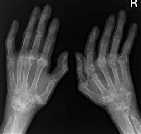 Sagittal Band Rupture Hand Orthobullets