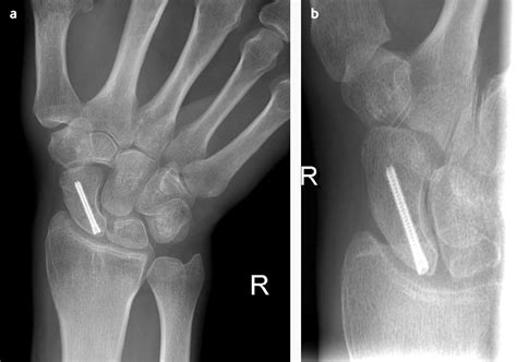 Fractures Of The Scaphoid The Bmj
