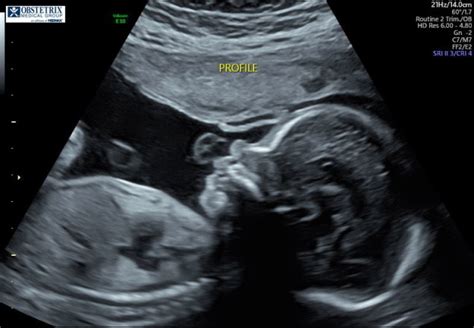 Baby Profile Ultrasound