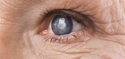 Who Performs Cataract Surgery Eye Associates Of Tucson Tucson