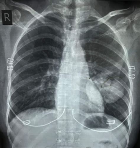 Vietnamese Medic Ultrasound Case 571 Lung Cyst Dr Phan Thanh Hai