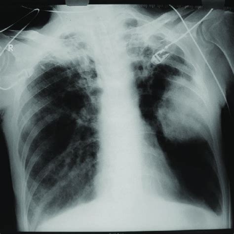Chest X Ray Showing Left Lung Mass Download Scientific Diagram